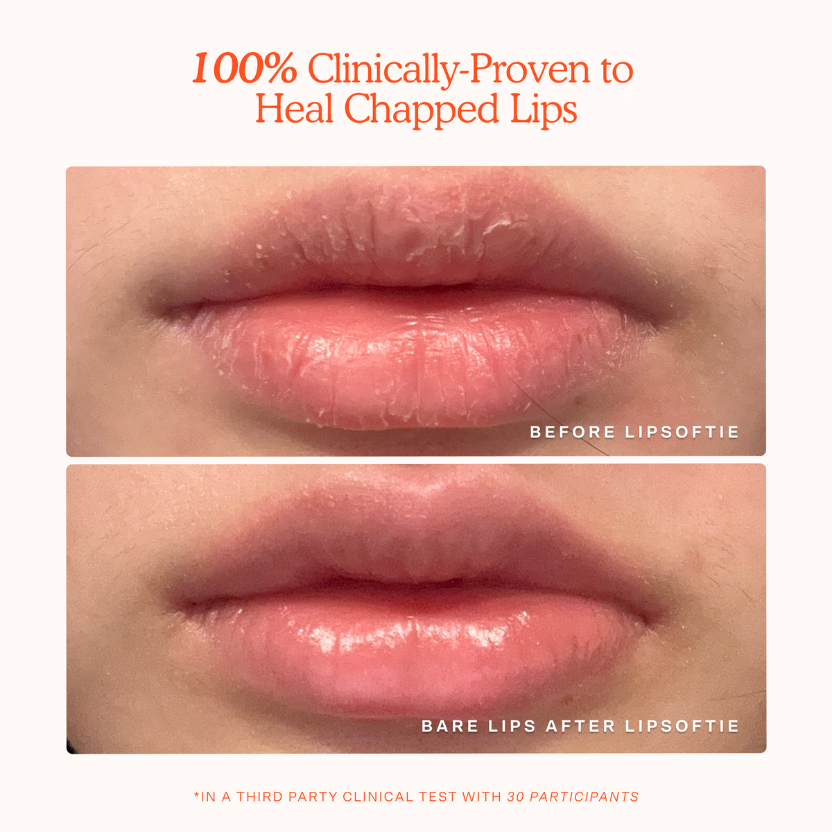 LipSoftie® Lip Treatment V9