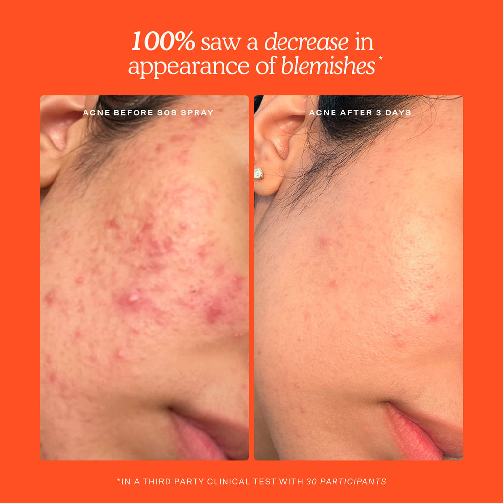 SOS Skincare Minis Kit X3